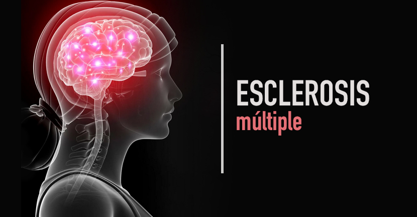 imagen del articulo Esclerosis Múltiple 